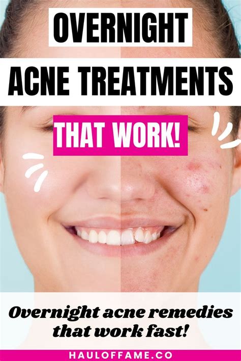 acnetrex|best overnight pimple treatment.